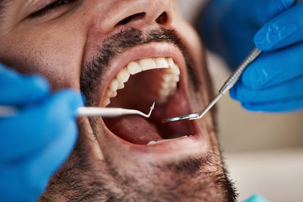 Best Emergency Root Canal Treatment in Flossmoor, IL